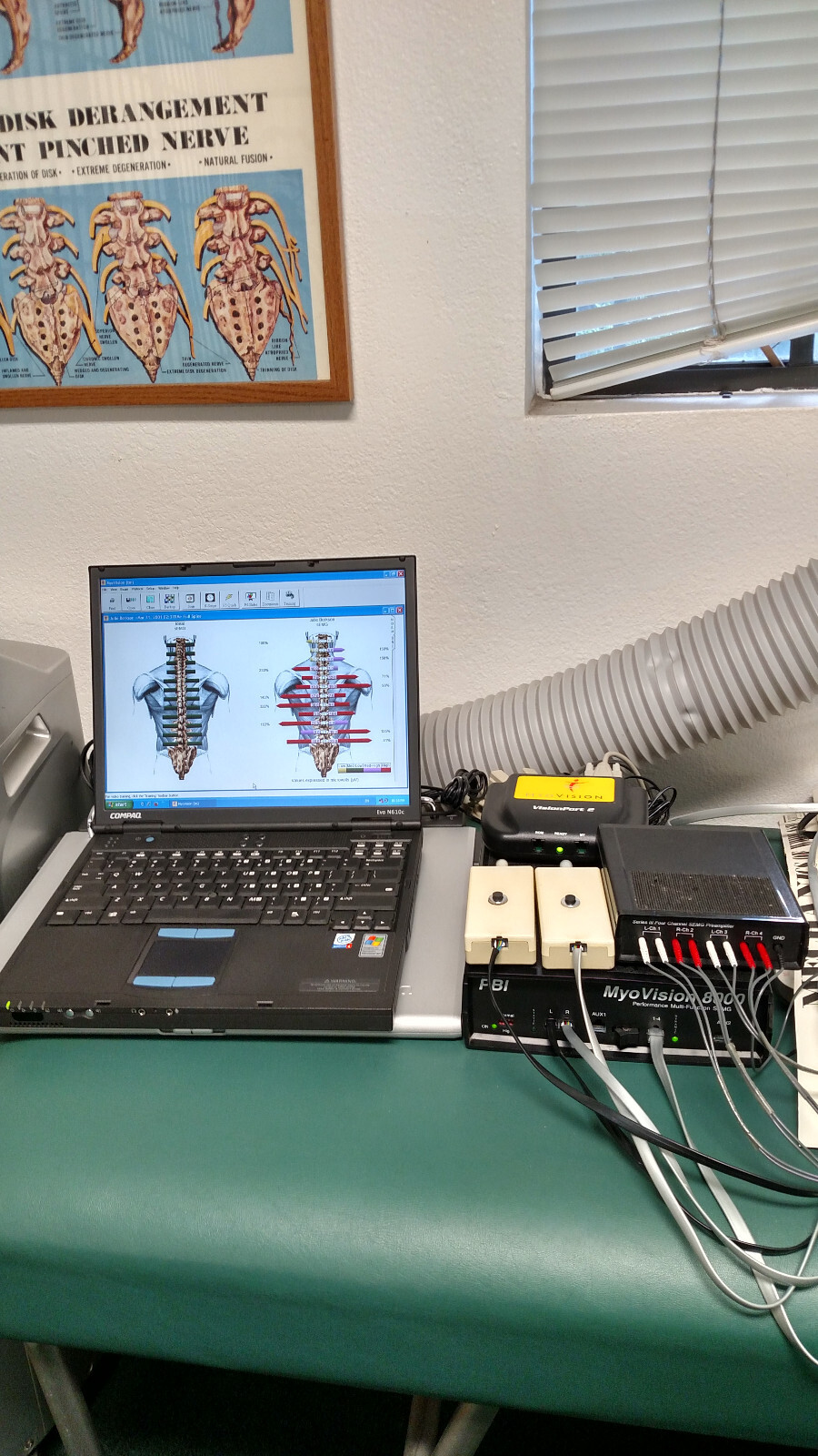Myovision 8000 Static sEMG with Validated Laptop Chiropractic Chiropractor